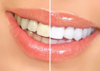 دندان های سفید